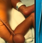 BEBáŠ BRASILEIRO NASCE COM CAUDA DE 12 CM E BOLA DE 4 CM NA EXTREMIDADE