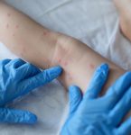 Vará­ola dos macacos: Ministério da Saúde monitora dois casos da doença no Brasil