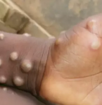 Vará­ola dos macacos é identificada em crianças pela primeira vez