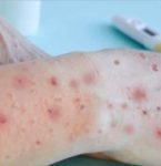 Crianças infectadas por vará­ola dos macacos na cidade de SP têm entre 4 e 6 anos, diz Prefeitura.