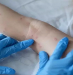 Vará­ola dos Macacos: Belém tem primeiro caso confirmado do Pará.