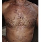 Homem internado com suspeita de varíola dos macacos, mas sintomas não seriam compatíveis