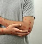 Boato sobre caso de varíola dos macacos em hospital de Capanema é desmentido pela instituição