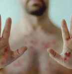 Varíola dos Macacos ainda assusta paraenses.